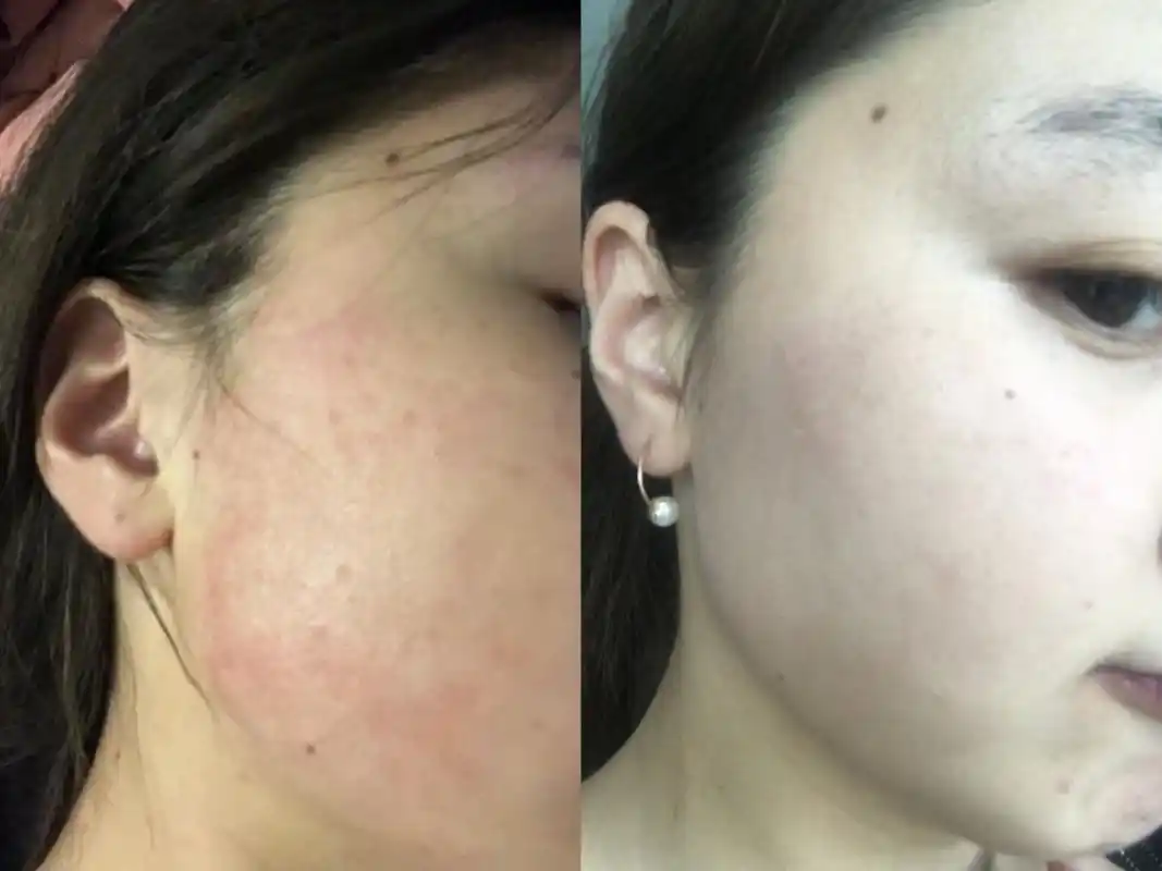 多年敏感肌终于稳定住啦