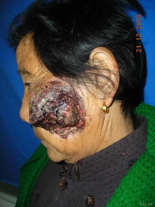 【请教】面部巨大鳞癌如何手术切除 - 皮肤与性传播疾病讨论版