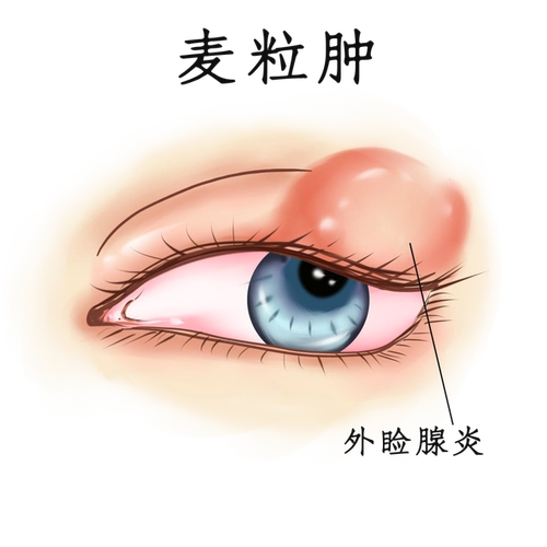 相信很多朋友都得过"麦粒肿",俗称"偷针眼".摘要:什么是麦粒肿?