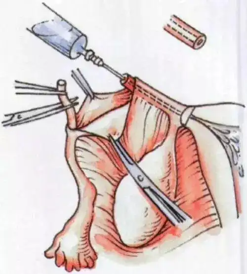 二胎剖宫产医生问我要不要输卵管结扎