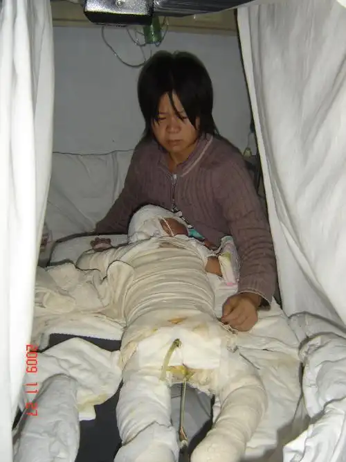 两岁烧伤的小宝宝小张颖在家继续用徐医生的药   全身都包满了纱布了