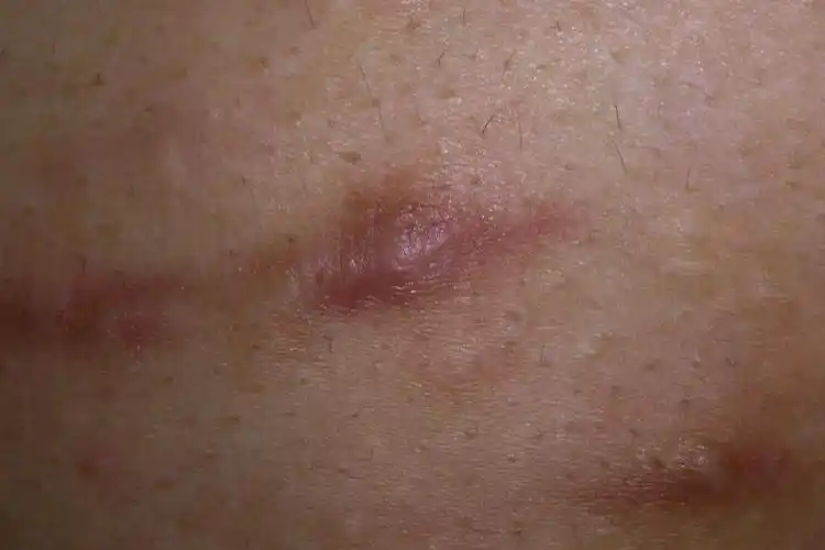 肥厚性瘢痕肥厚性瘢痕可发生在任何部位,病变部位通常有外伤手术,烫伤