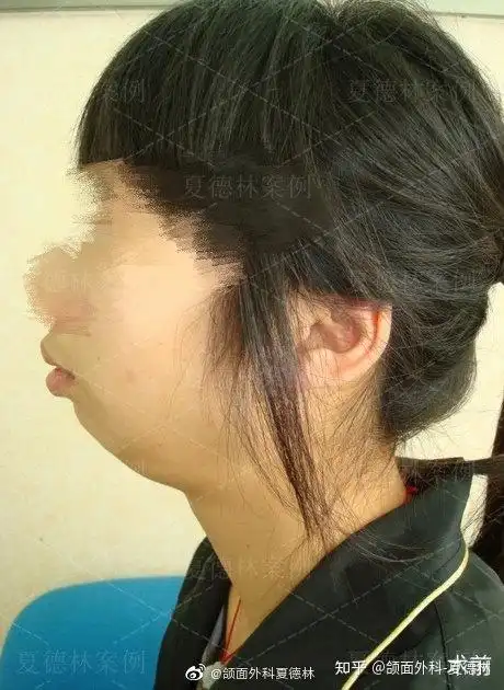 不会,偶尔打哈欠也会有咯噔一声,不疼 请问我这个是颞下颌关节紊乱吗