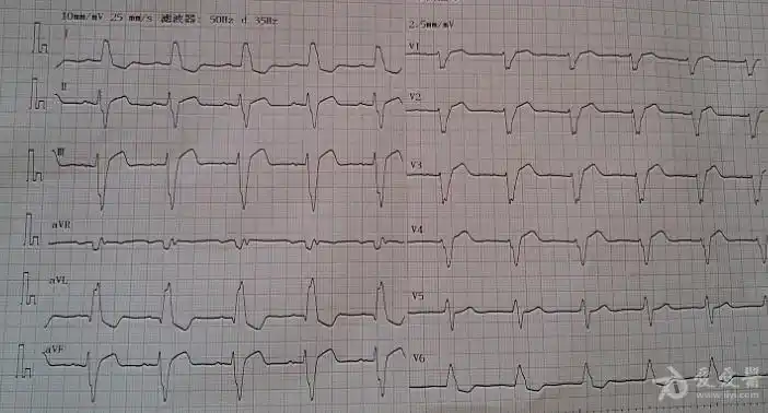 完全性左束支传导阻滞心电图