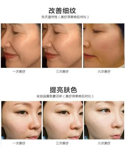 韩国vmax雷达线雕美容仪器提拉紧致祛皱超声刀无针精雕仪美容院