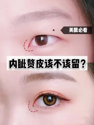 内眦赘皮会影响眼睛的形态吗?