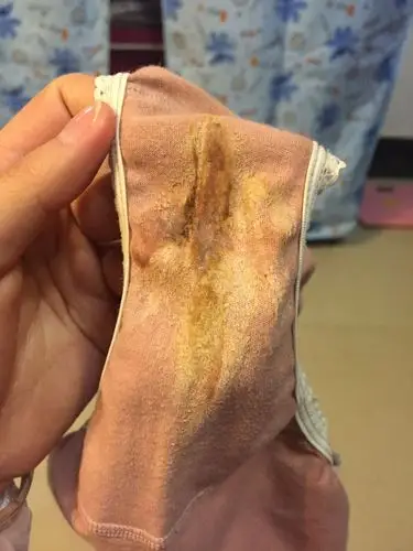 满意回答 你好,白带异常可能是妇科炎症导致的症状,建议淡盐水勤洗