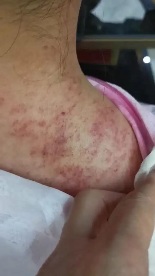 再给刮了一下,这个痧啊猛冒,道圣康膜买一盒回家擦肩颈,谢谢信任