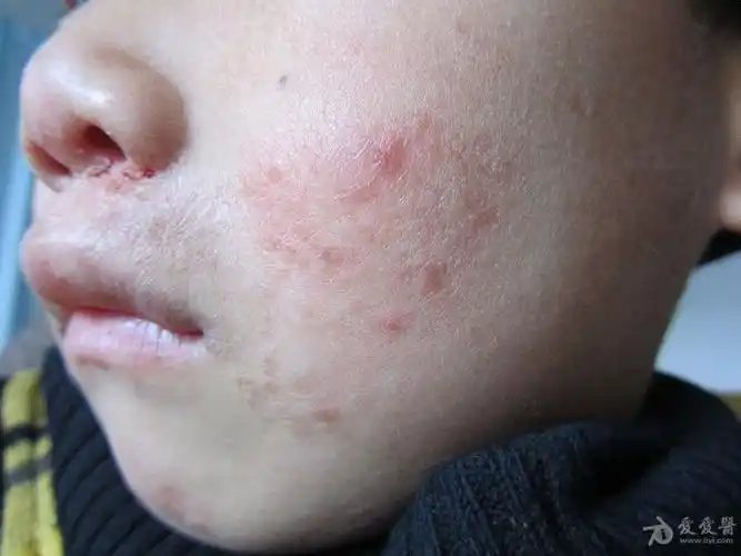 患儿面部的皮损面部湿疹