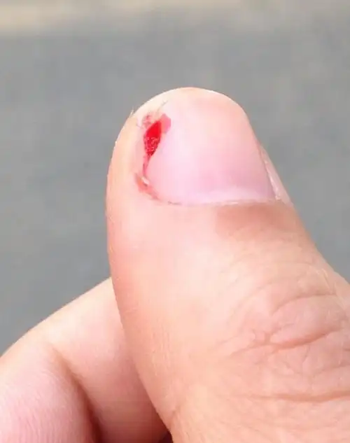 手指甲伤成这样,还能长好吗?还是以后都会有一个缺口?如图