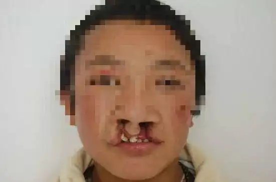 唇腭裂胎儿是如何产生的?如何预防?