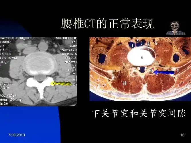 免费文档 所有分类 高等教育 医学 椎间盘突出症的ct表现ppt 腰椎ct的