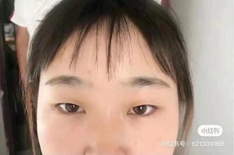 桃花双眼皮.双眼皮恢复的时间需要多久.