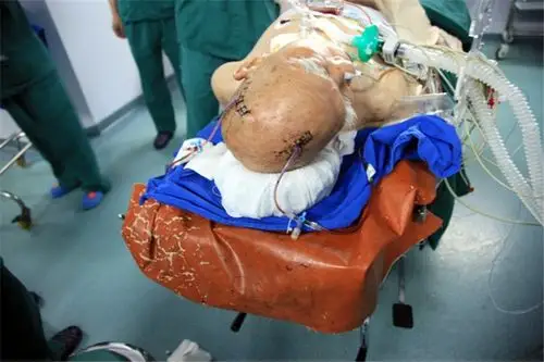 脑疝手术十字点标记开颅点图片