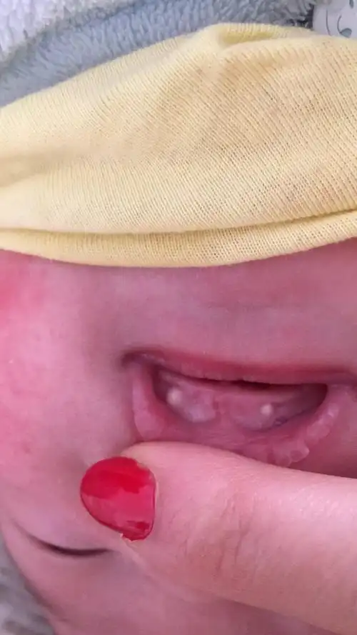 马牙对宝宝有什么影响吗