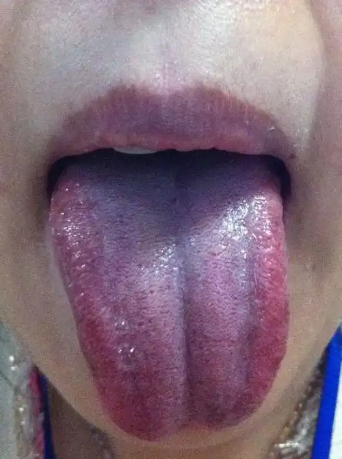 舌苔颜色越来越不好.