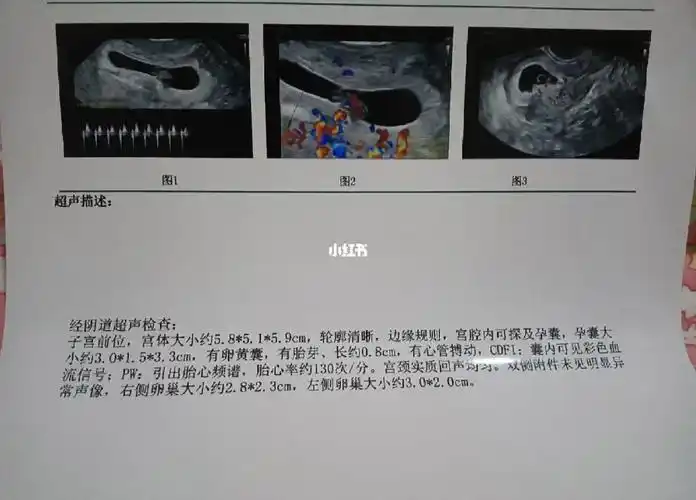 试管移植第28天胎心胎芽终于出来咯