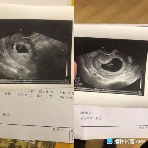 [试管婴儿]28天今天35天2超宝宝在一点