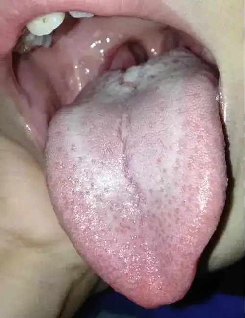 图文并茂看懂儿童舌苔