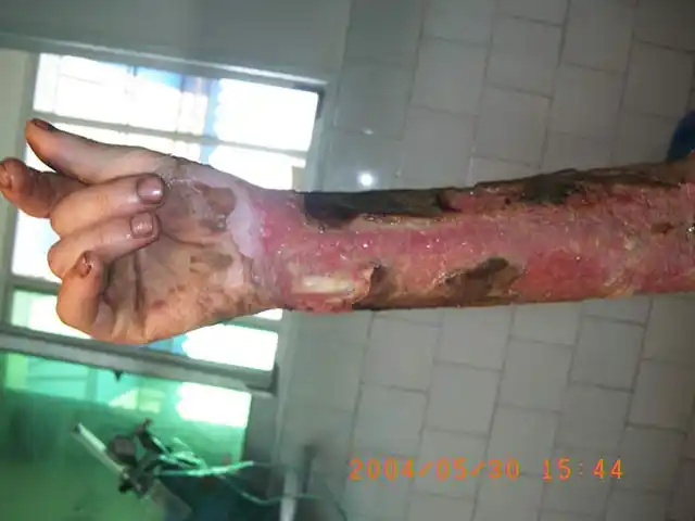四川什邡川磷烧烫伤专科医院救治的一例特大面积烧伤患者