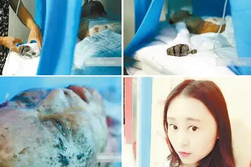 杨冬玲原本容貌清秀,如今全身多处严重烧伤.网上图片