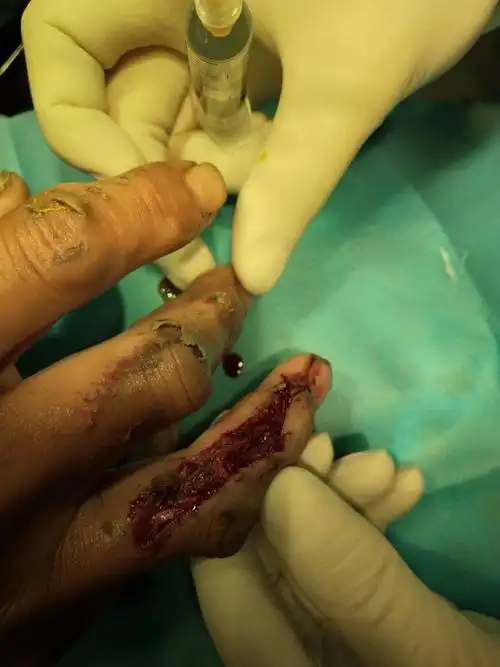 鲁山红辉诊所手术篇 手挫裂伤