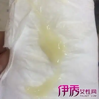 【图】医学提供正常白带图片 教你了解并正确认识白带