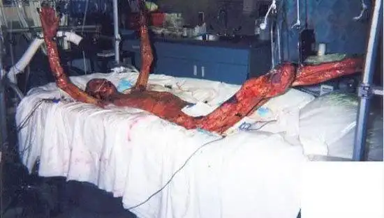 世界上最痛苦的死亡---日本东海村核临界事故