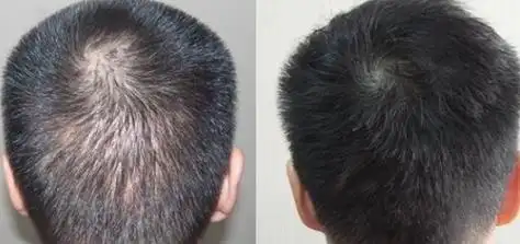 毛发移植的原理是什么 毛发嫁接的价格一般是多少