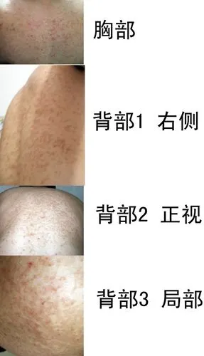 皮肤病,无规则的神色花斑,分布于胸部和背部,夏天尤为明显.谢谢!