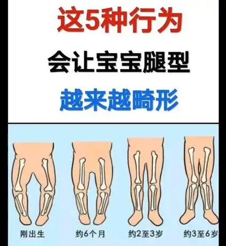 5种行为会让宝宝腿型越来越畸形 1岁以内:婴幼儿腿部会呈椭圆状