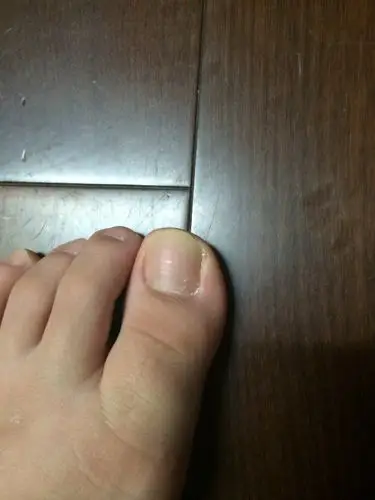 这种情况算是灰指甲初期症状吗?还是普通的多死皮或是什么?