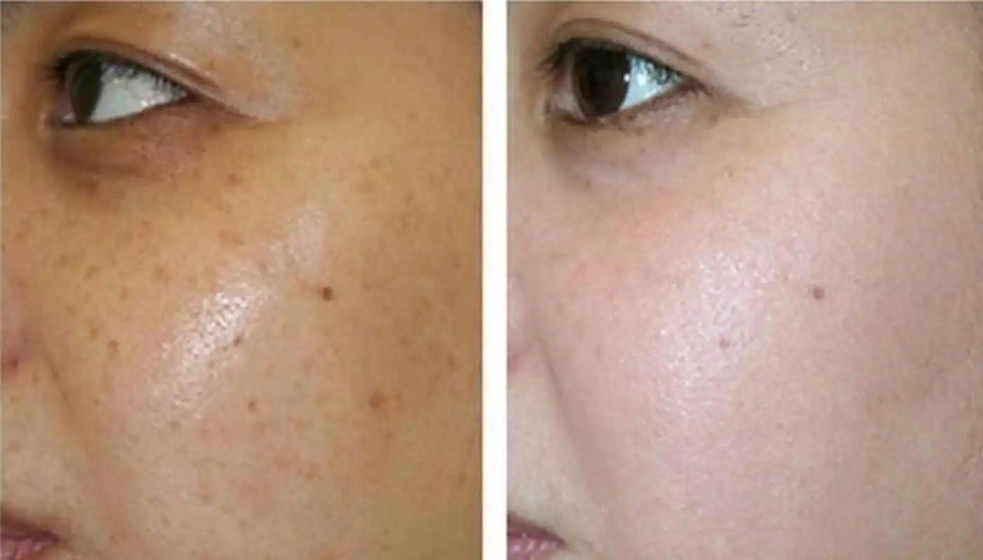 肝毒深,4种丑态藏都藏不住 1,脸色暗沉 皮肤发黄暗沉,而且分布不均匀