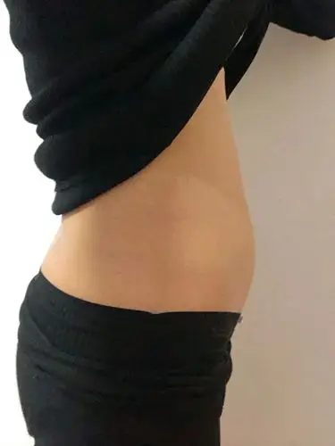 腰腹环吸第八天对比昨天拆线(术后第七天),今天就贴_圈子-新氧美容