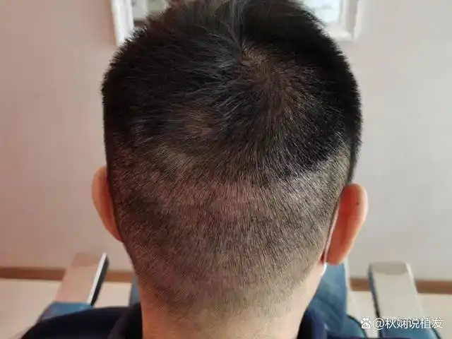 植发为什么要剃光头?看完再去做植发,不然做完植发会后悔