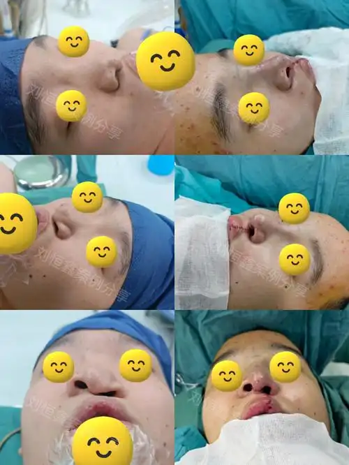 最近手术都结束比较晚 唇裂修复 唇裂鼻修复