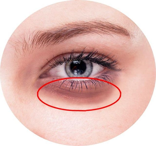 眼袋or 黑眼圈,傻傻分不清楚?_去眼袋_去眼袋治疗介绍 - 好大夫在线