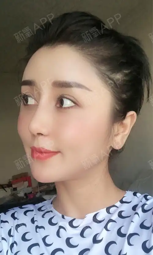 软骨隆鼻好不好_效果图_黎明之后肋软骨隆鼻术后第15天_新氧美容整形