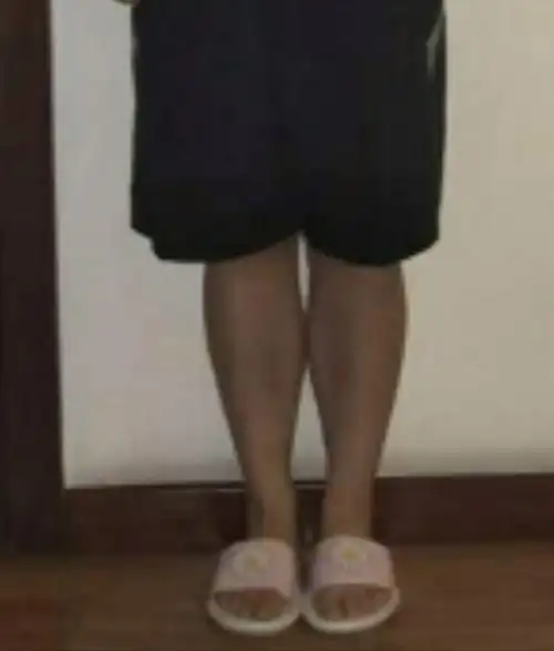 有没有姐妹小腿内侧肌肉突出的