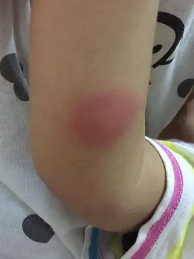 虫咬性皮炎图片 (109)_有来医生