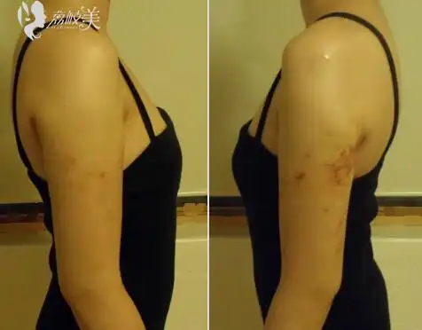 360度维秘吸脂术-女子手臂吸脂手术2周后的效果图!