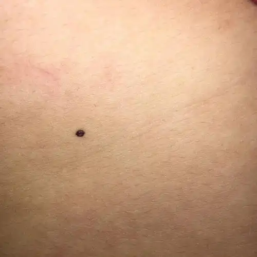 去年肚皮上的痣有些发痒,如图1,长得黑黑的微微凸起中间有个肉点,在