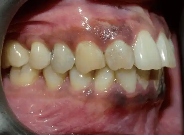 颌骨内异常结构病变的诊断过程陈志平教授