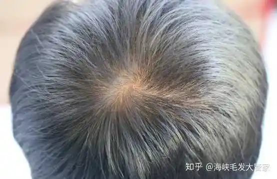 (图示,早期脱发症状:头发变细变软,头顶发量开始减少)