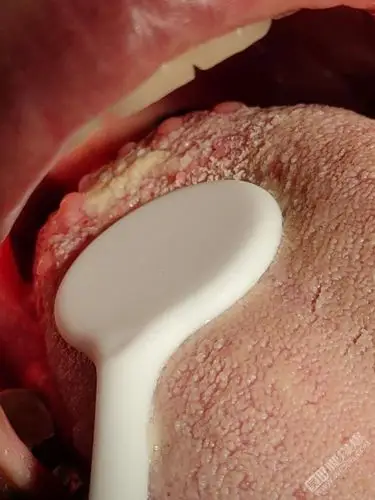 舌头里面长了很多这样的泡,爆友们知道去哪里看比较好吗?