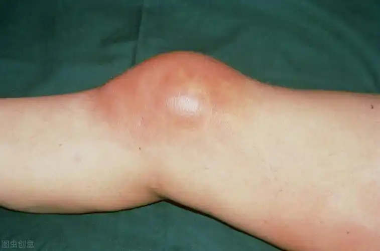 20大学生被送进医院,诊出滑膜炎,医生直言:是这3种坏习惯导致