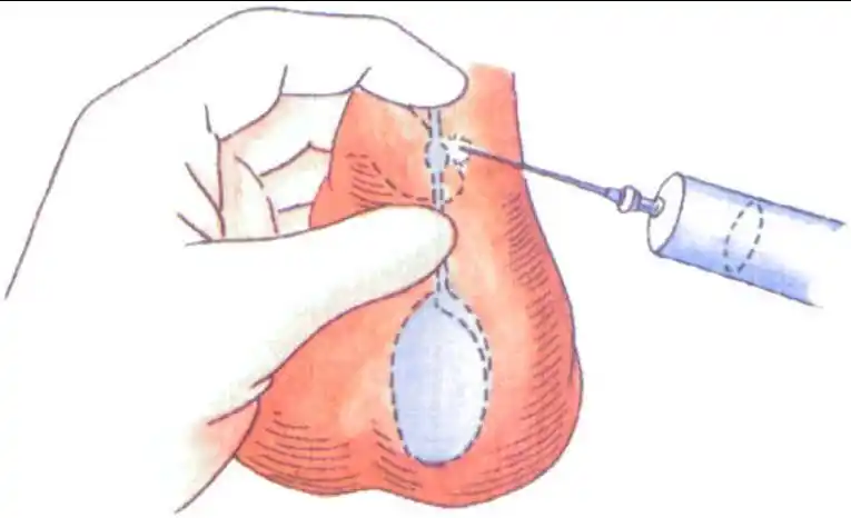 手术者视力不好时,强调应用显微镜.【适应症】1.