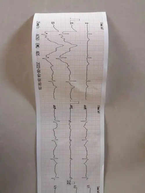 一会就好了  #心电图  #心内科  #胸闷08-11回复窦性心律  电轴左偏