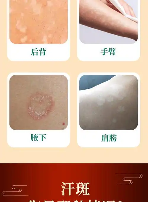 汗斑净汗斑专用去i花斑藓火斑白斑胸前背部片状药i膏