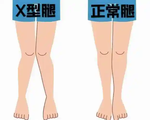 x型腿矫正教你改善x型腿